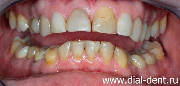 вид зубов до лечения и протезирования