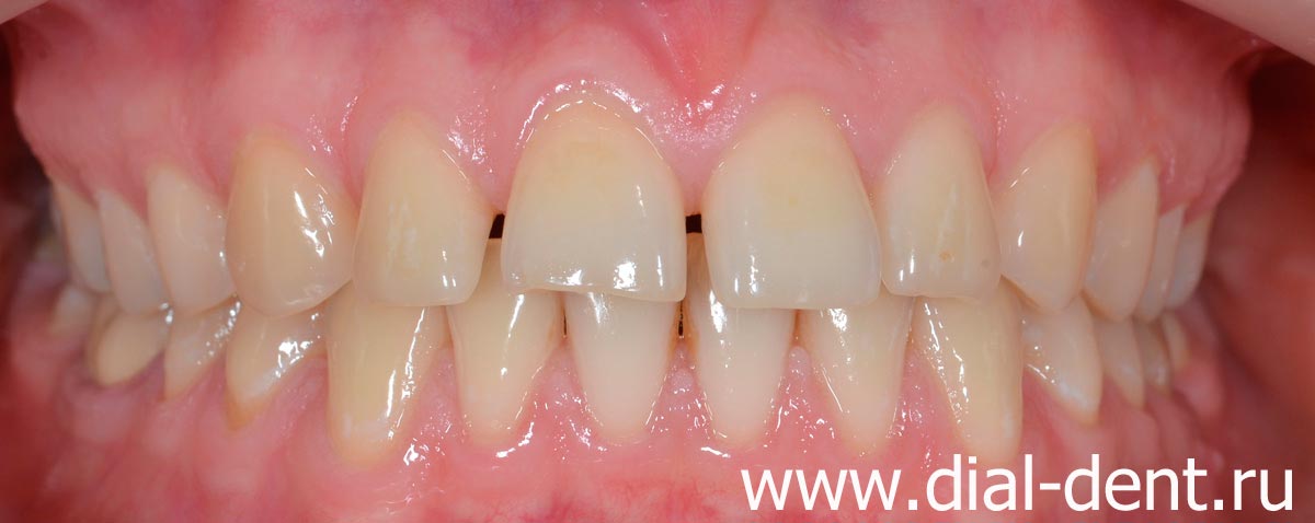 щели между зубами, стертые края зубов, смещение центра верхних зубов, желтый цвет зубов