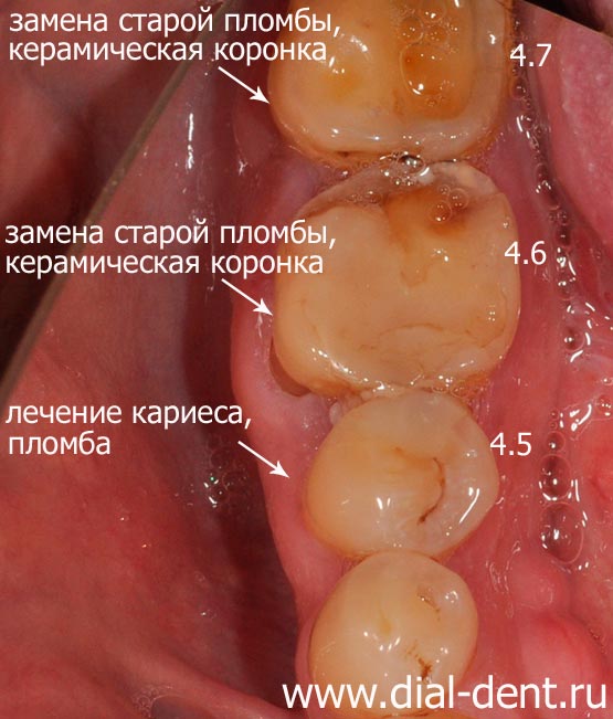 план лечения нижних зубов