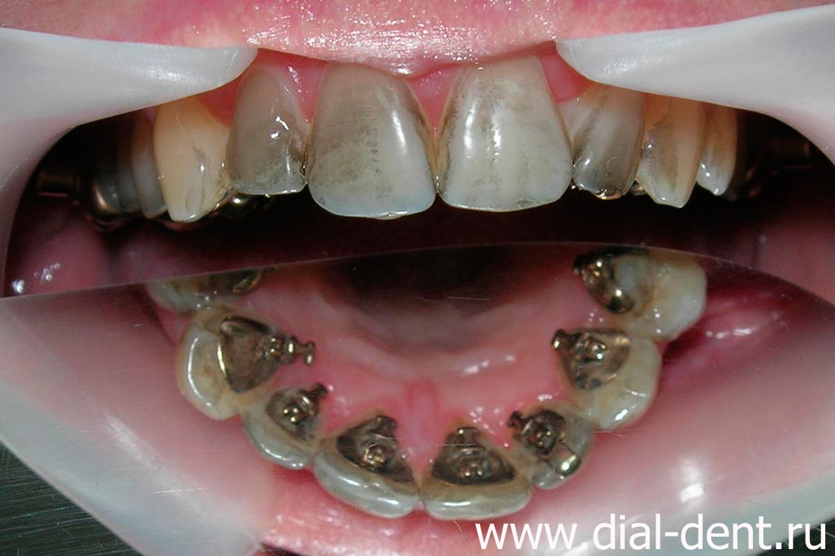 скопление зубного налета у десен и между зубами