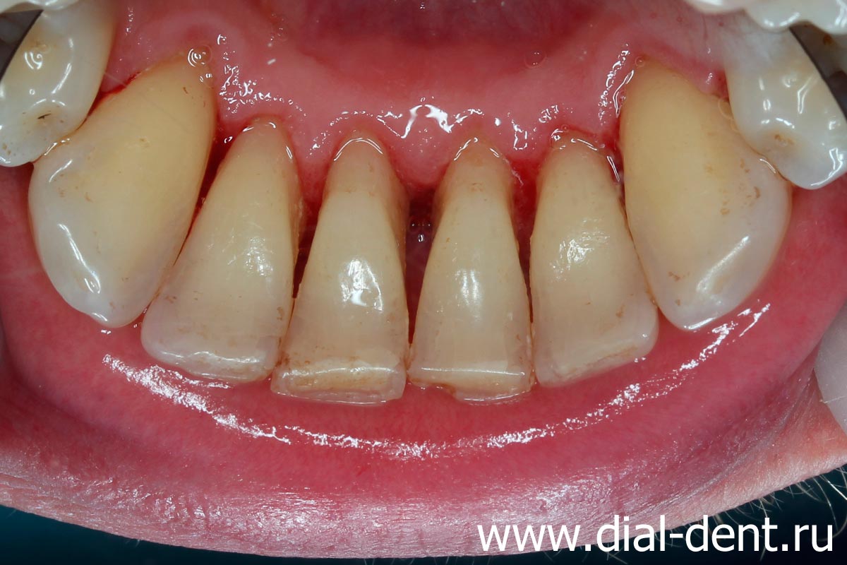 результат чистки зубов ультразвуком - полное удаление зубных отложений