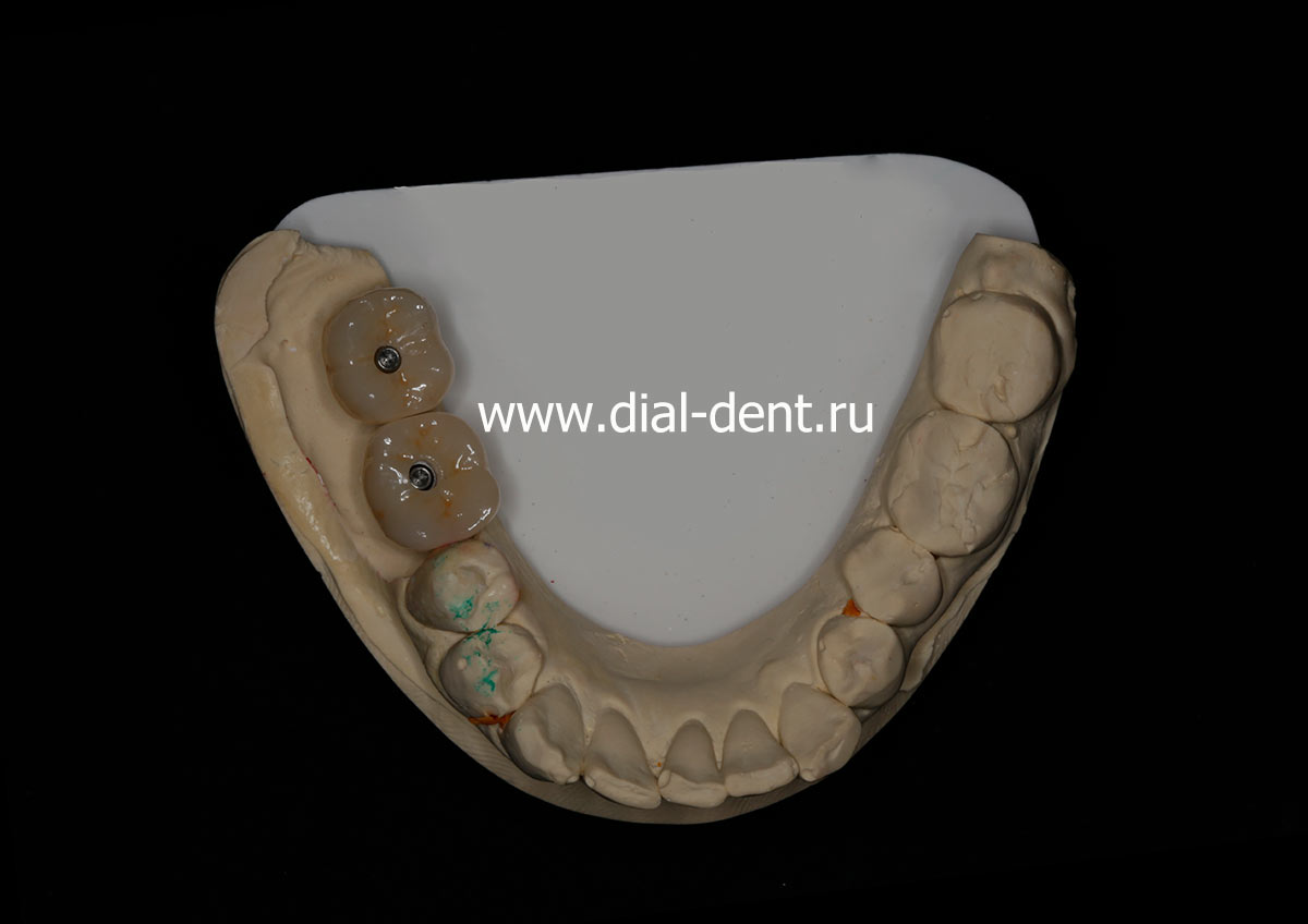 зубные коронки с винтовым креплением к имплантам на модели зубов