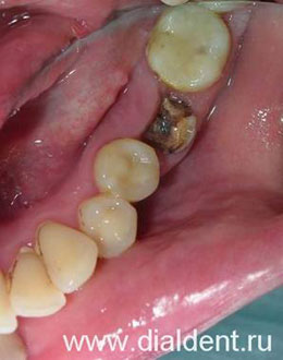 сильно разрушен зуб