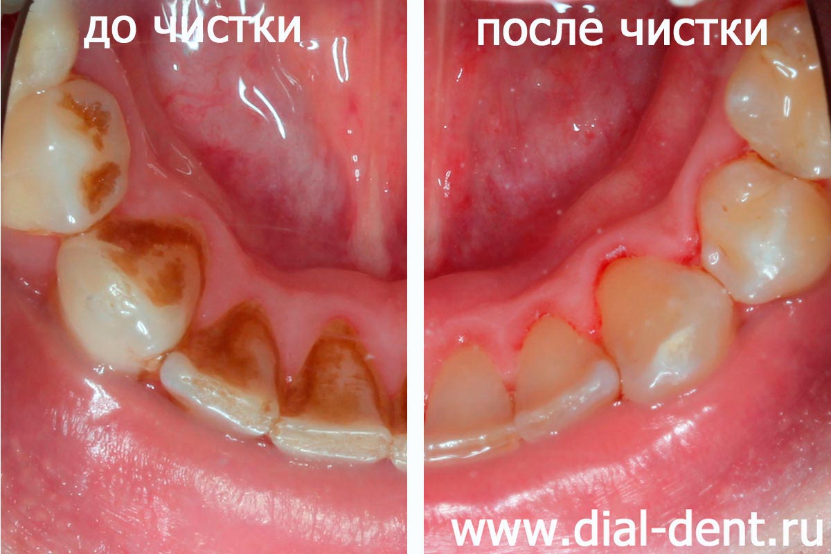 зубной камень до и после профессиональной чистки зубов