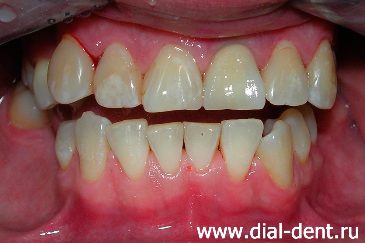 проведена гигиеническая подготовка перед комплексным стоматологическим лечением