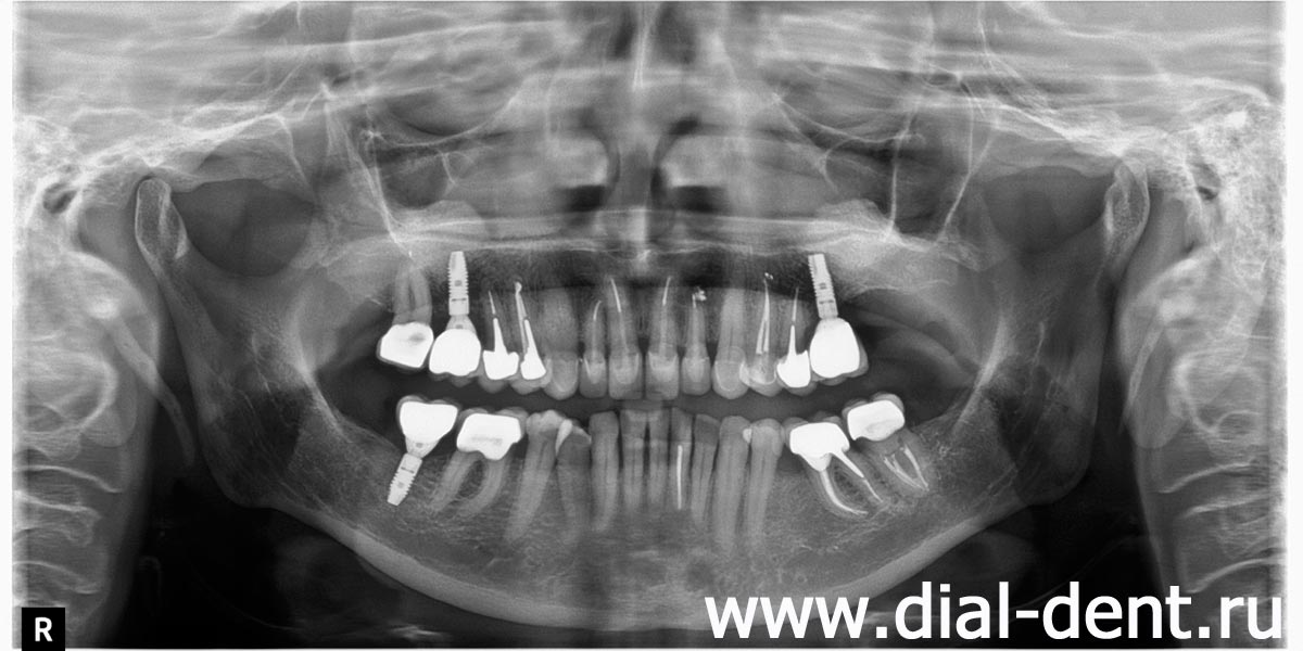 панорамный снимок после имплантации зубов и протезирования