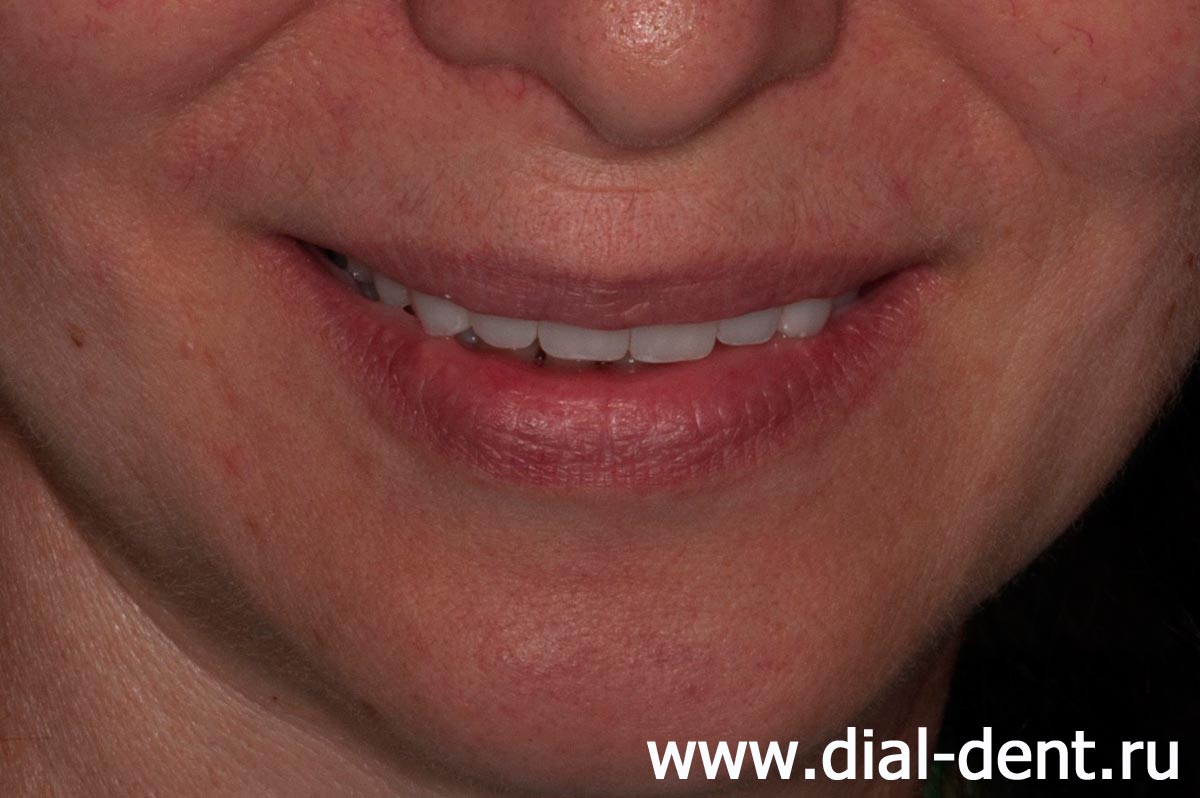 после лечения, имплантации и протезирования зубов в Диал-Дент