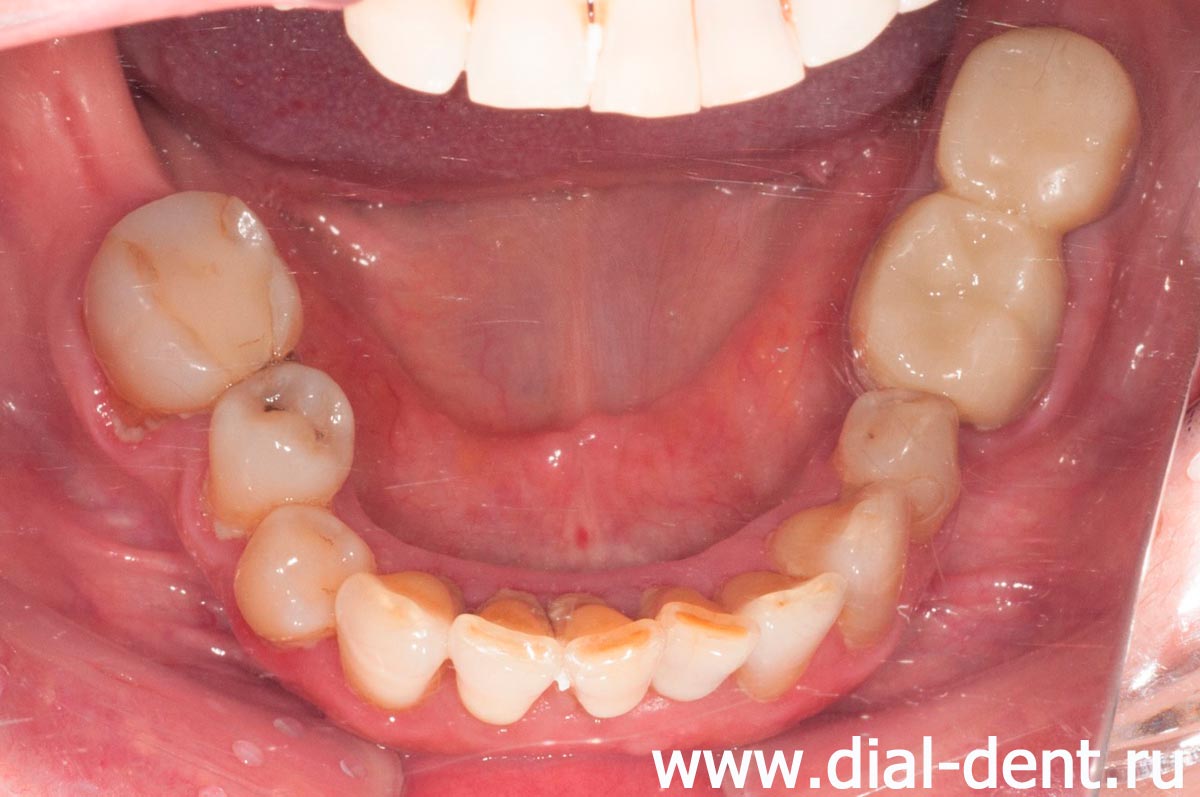 нижние зубы после лечения каналов, удаления зубов и одномоментной имплантации