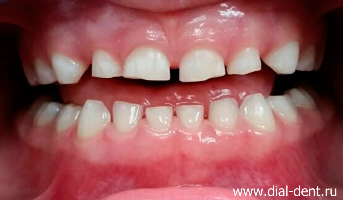 молочные зубы после профессиональной чистки налета Пристли