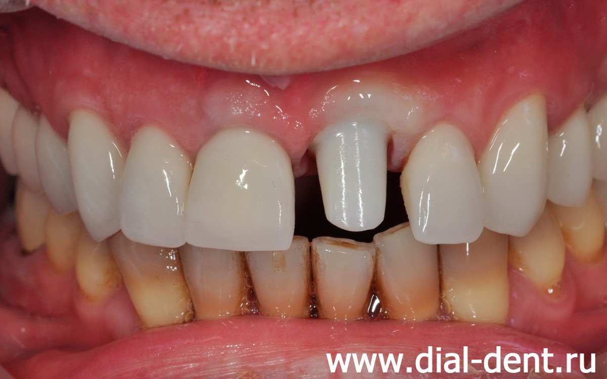 индивидуальный абатмент для протезирования переднего зуба на импланте