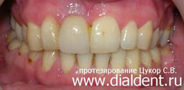 протезирование зубов мостовидным протезом