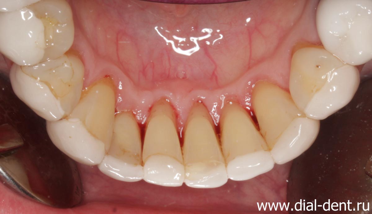 нижние зубы после чистки Air Flow