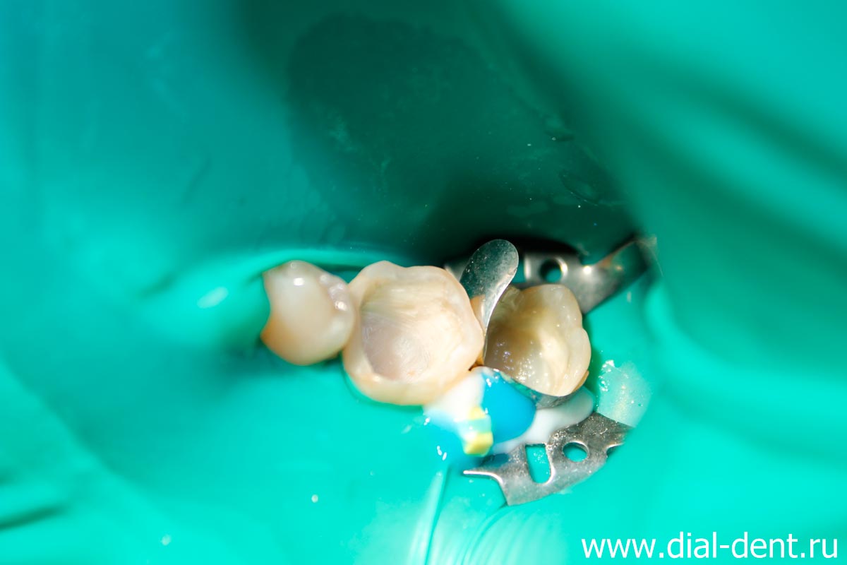 лечение зубов в Диал-Дент