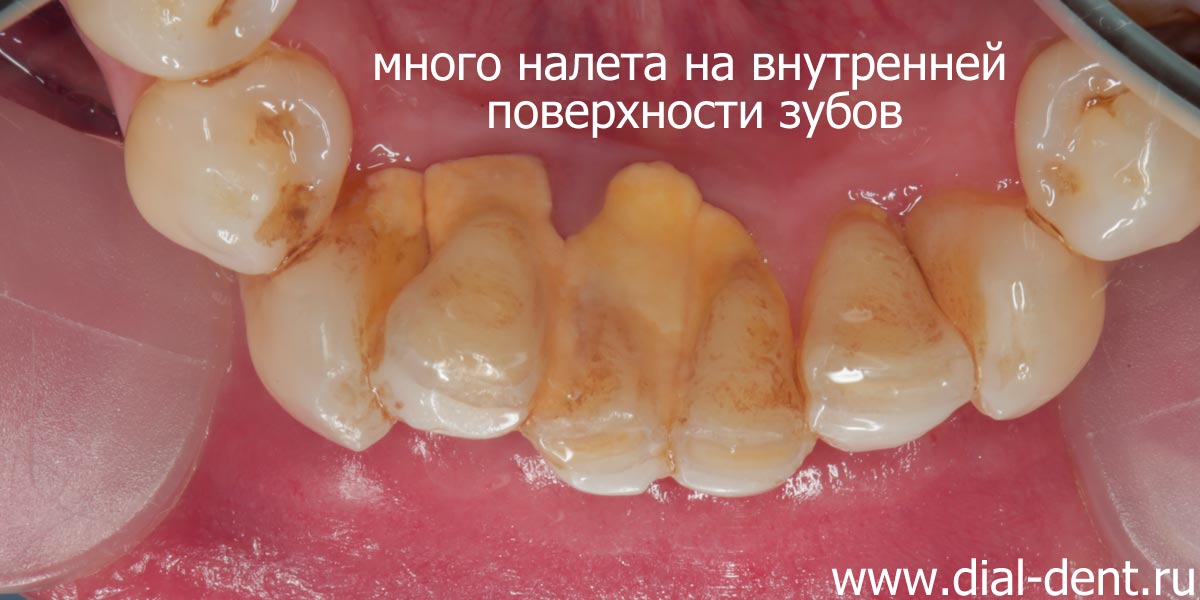 внутренняя поверхность зубов до профессиональной чистки в Диал-Дент