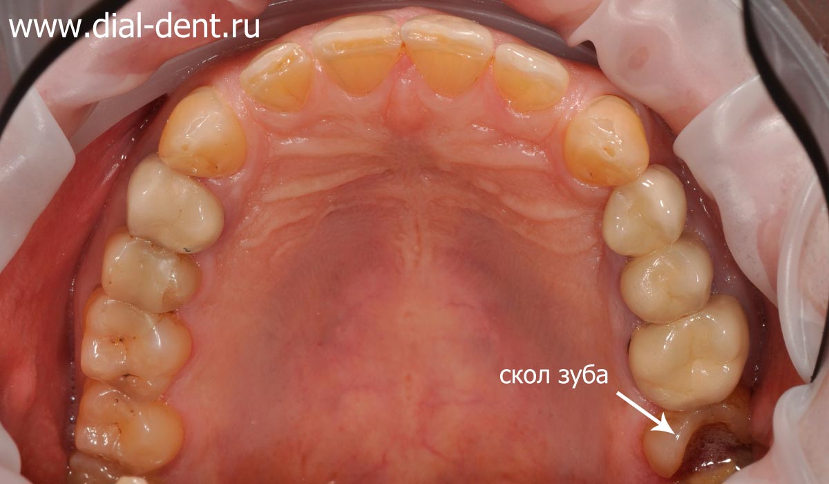 пациент обратился со сколом зуба, обнаружен необратимый пульпит
