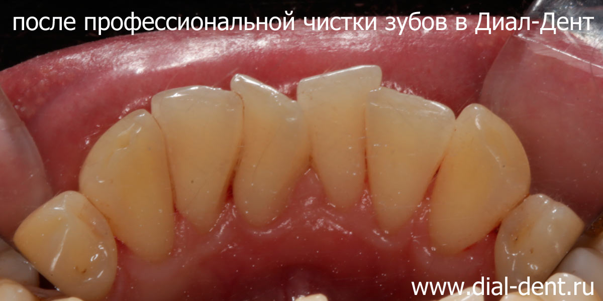 полное удаление зубного налета и зубного камня после профессиональной чистки зубов