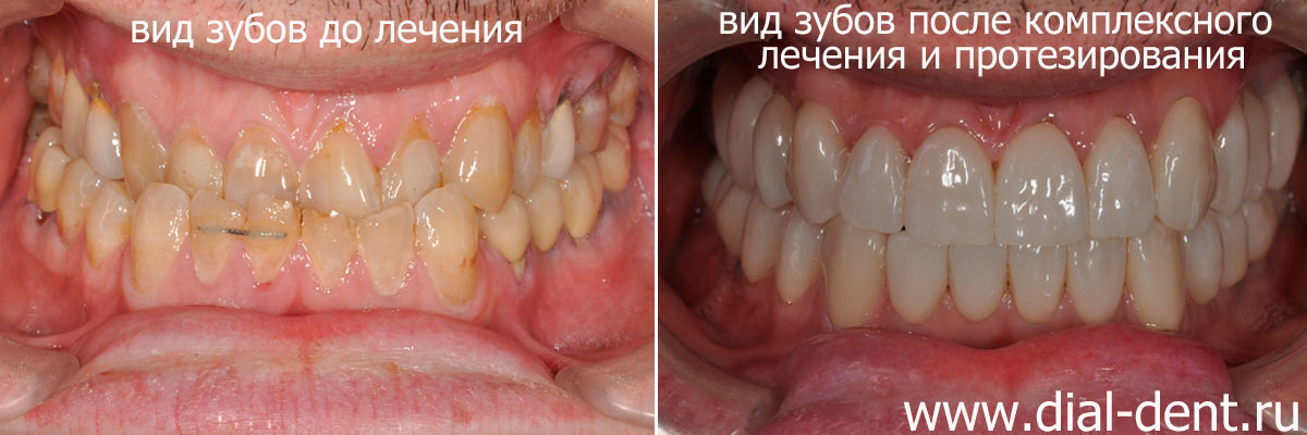 вид зубов до и после комплексного лечения и протезирования в Диал-Дент