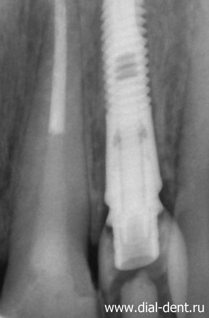 зубной имплант установлен сразу после удаления зуба