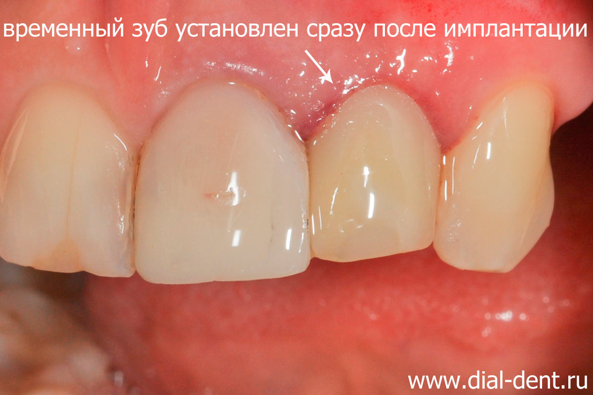 временный зуб на импланте