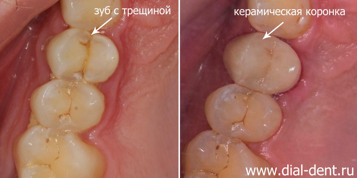вид зуба до и после протезирования