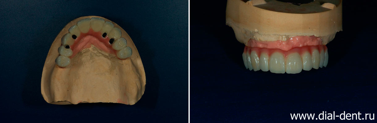 несъемный протез на имплантах для восстановления верхних зубов