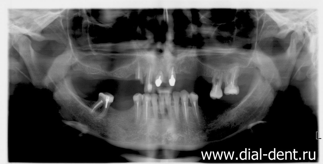 панорамный снимок зубов до лечения - нет зубов, снижен уровень кости челюсти