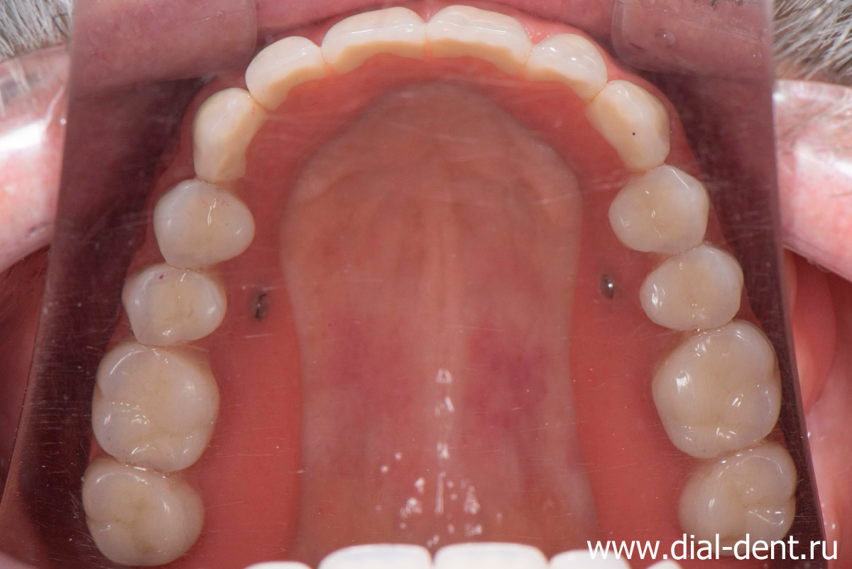съемный зубной протез верхней челюсти с креплением на имплантах
