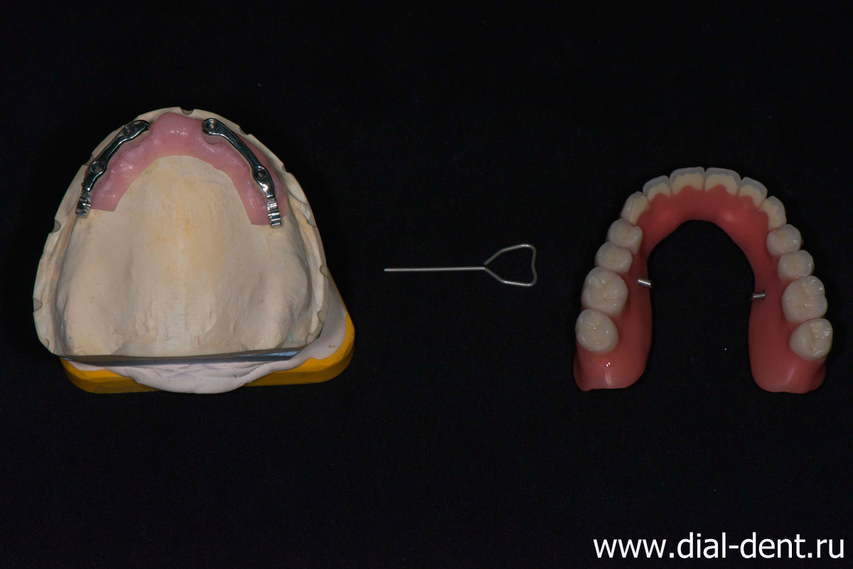 съемные зубные протезы на модели в лаборатории Диал-Дент