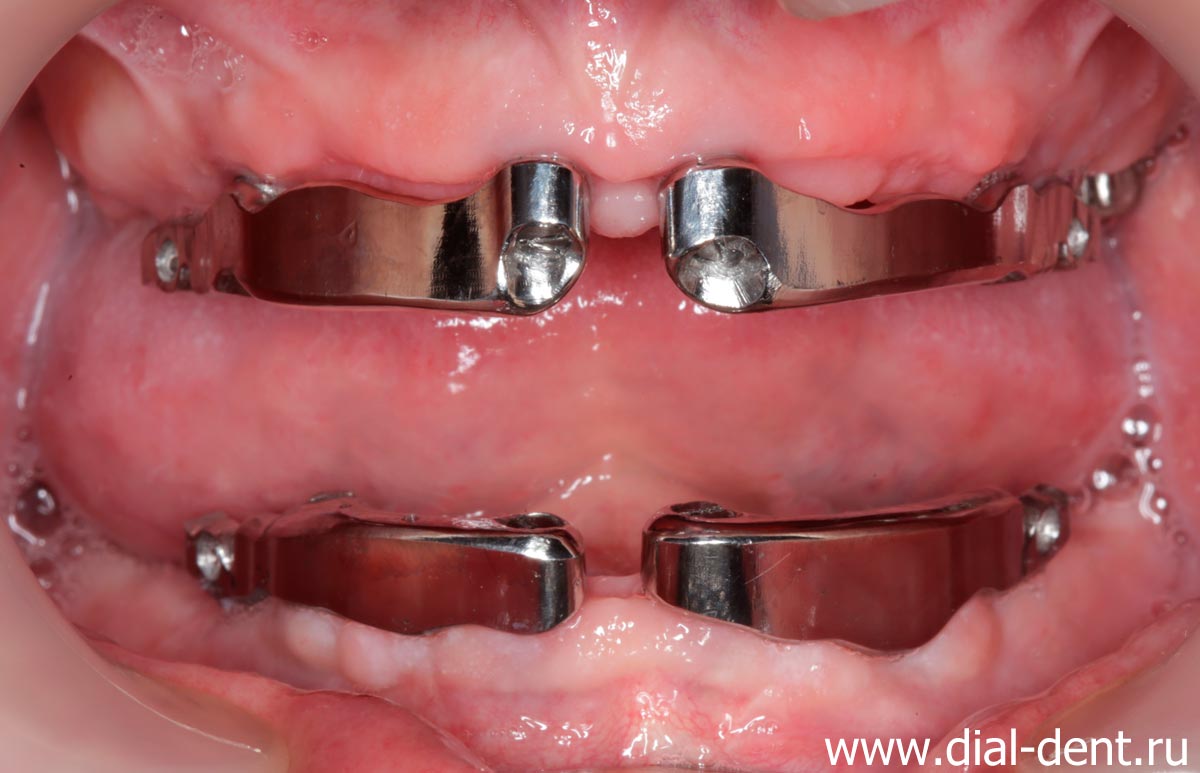 балки на имплантах для закрепления съемных зубных протезов