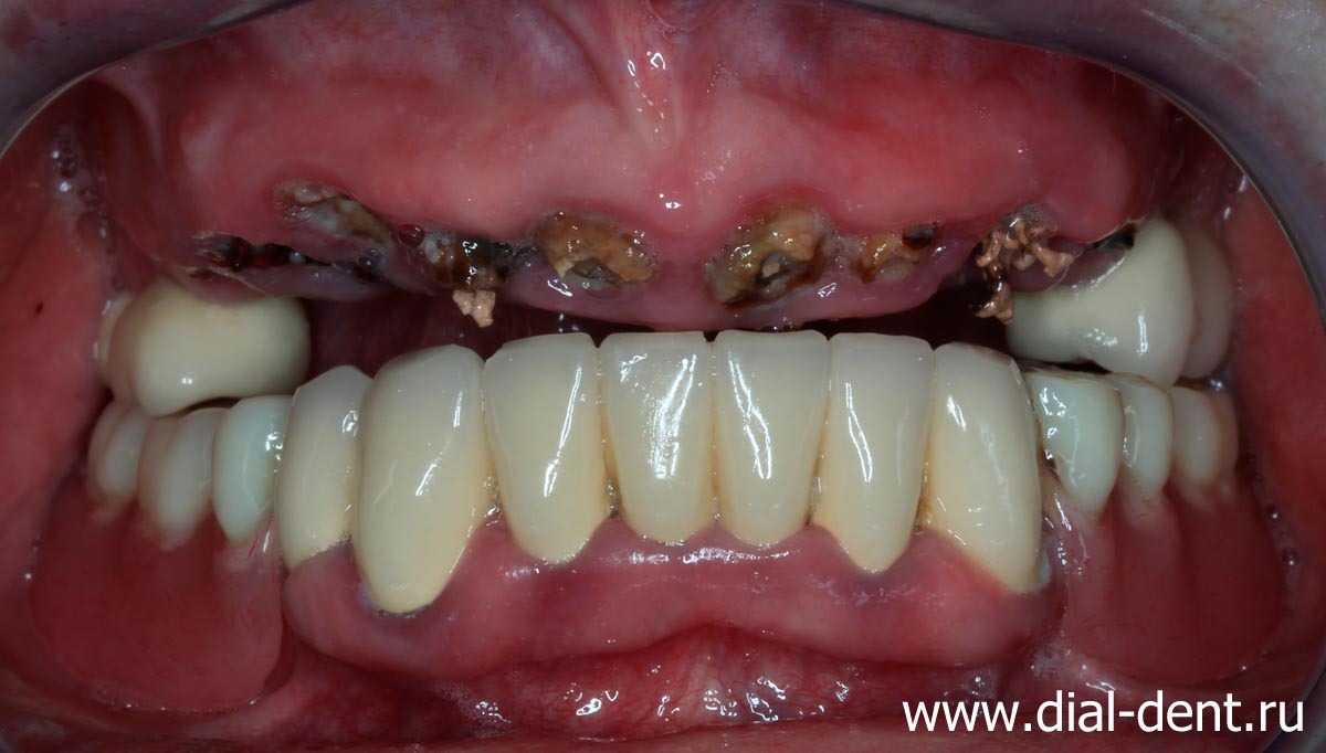выпал металлокерамический протез верхних зубов