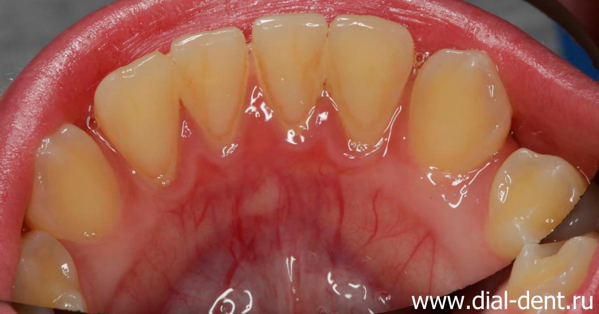 много налета на внутренней поверхности нижних зубов