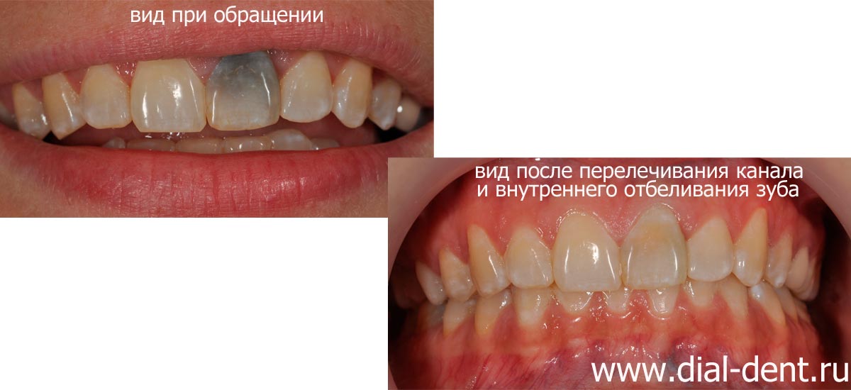 результат внутреннего отбеливания зуба