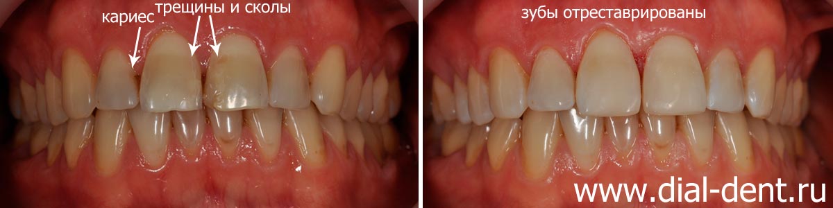 до и после реставрации передних зубов