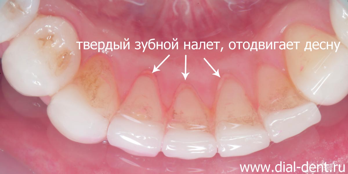 налет на зубах с внутренней стороны приводит к отодвиганию десны от зуба