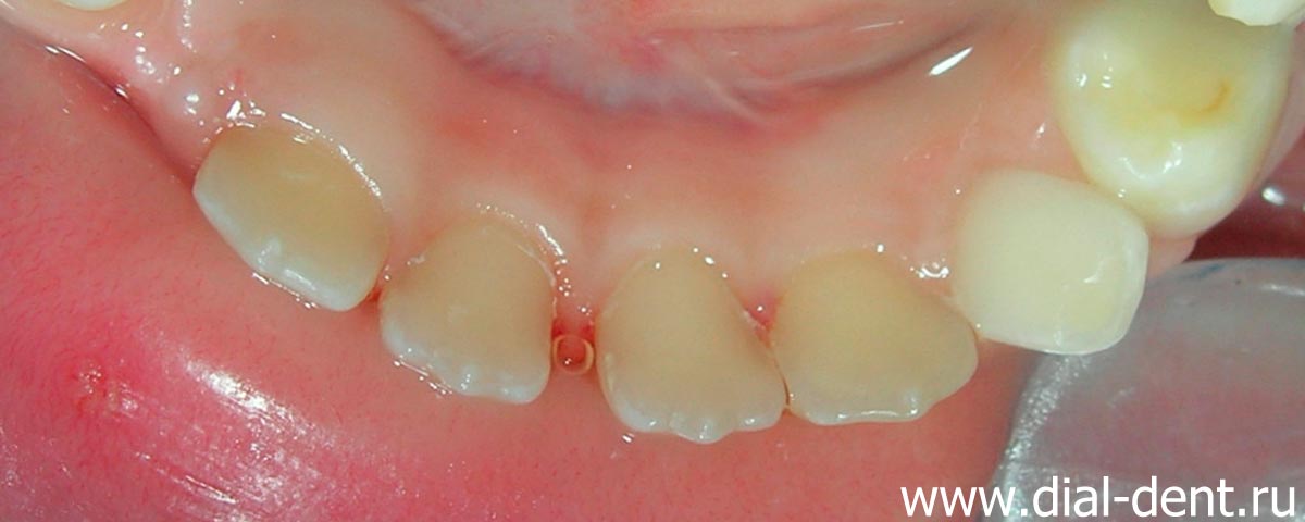 зубной налет полностью удален с внутренних поверхностей зубов