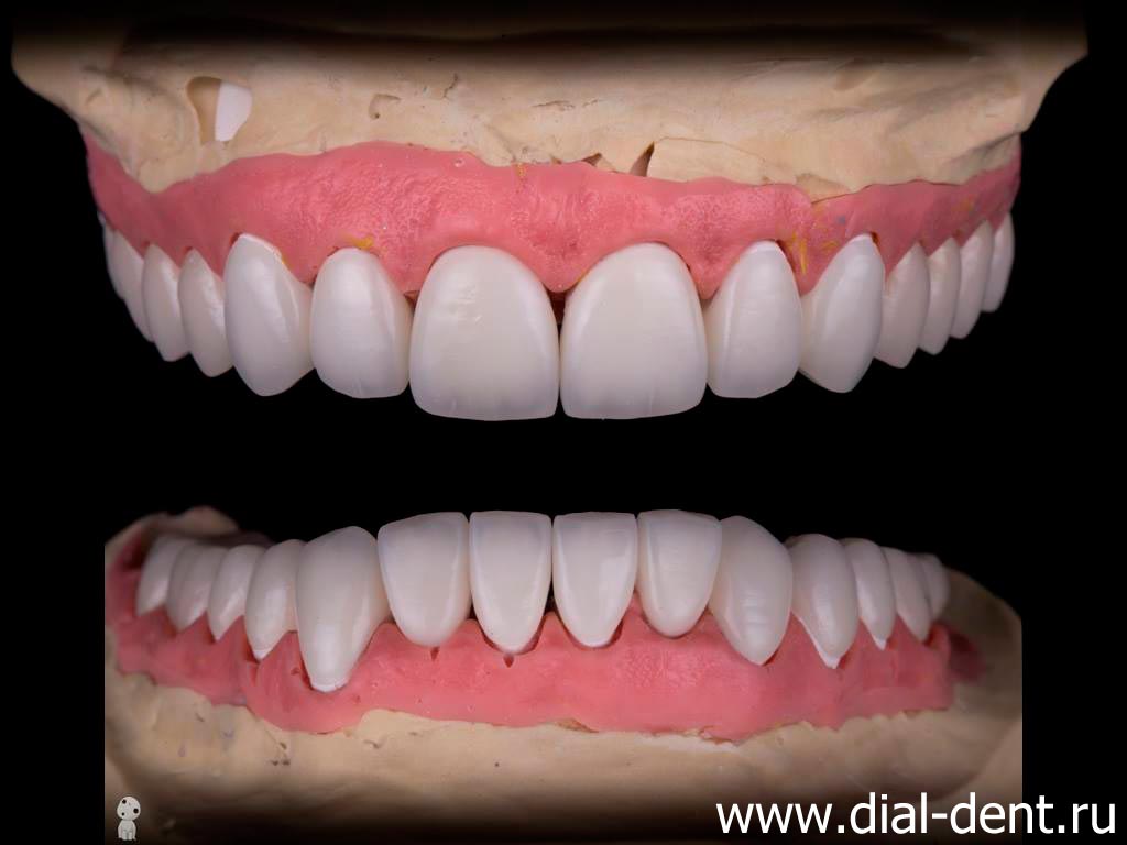 керамические коронки и виниры на модели зубов