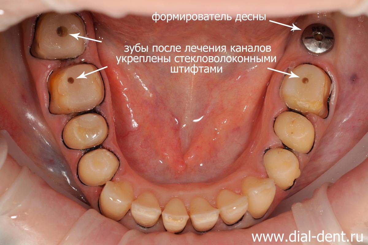 зубы после лечения каналов укреплены штифтами, установлен формирователь десны на имплант, зубы подготовлены под коронки