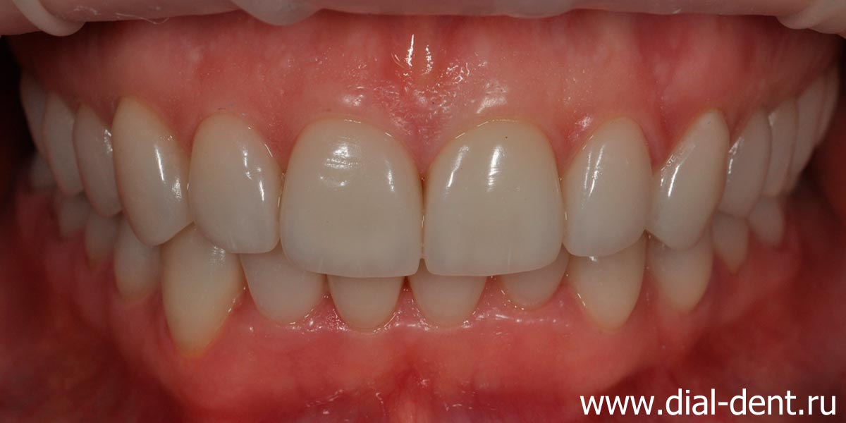 вид зубов после протезирования керамическими коронками и винирами