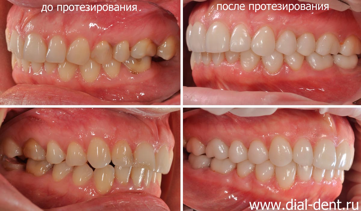 вид зубов до и после протезирования керамическими коронками и винирами