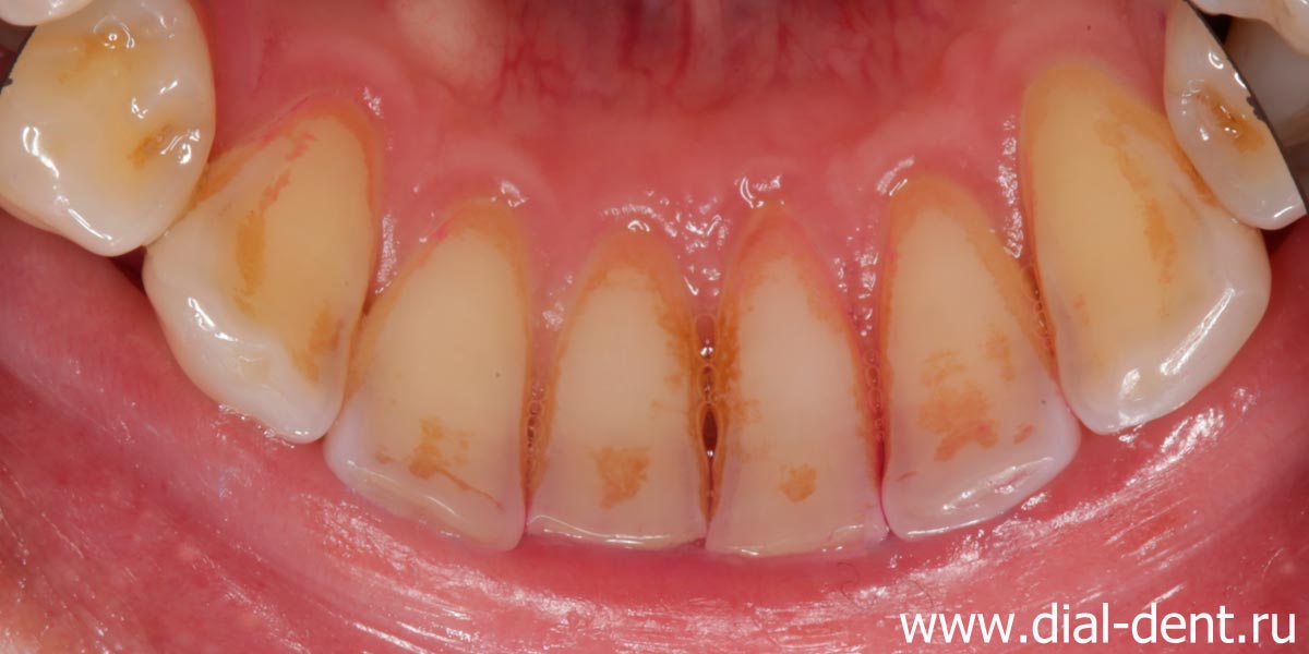 налет и зубной камень на нижних зубах с внутренней стороны