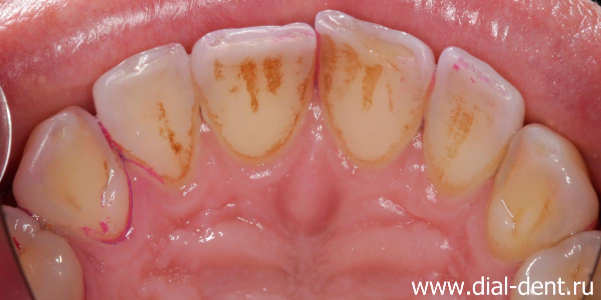 налет и зубной камень на верхних зубах с внутренней стороны