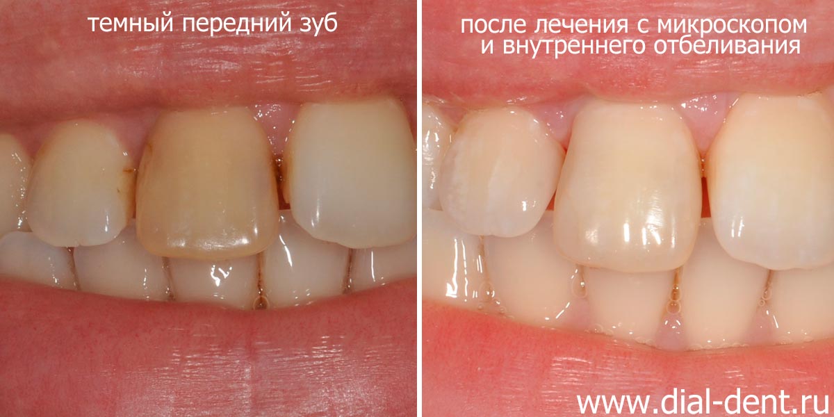 передний зуб до и после лечения и отбеливания