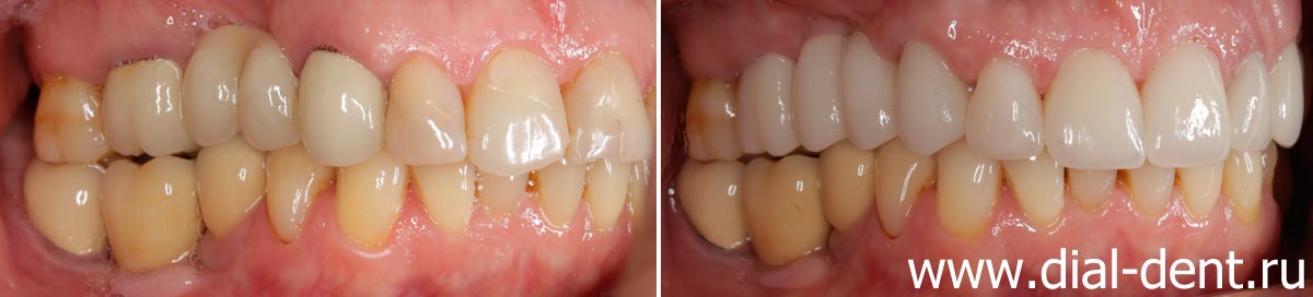 вид зубов справа до и после протезирования