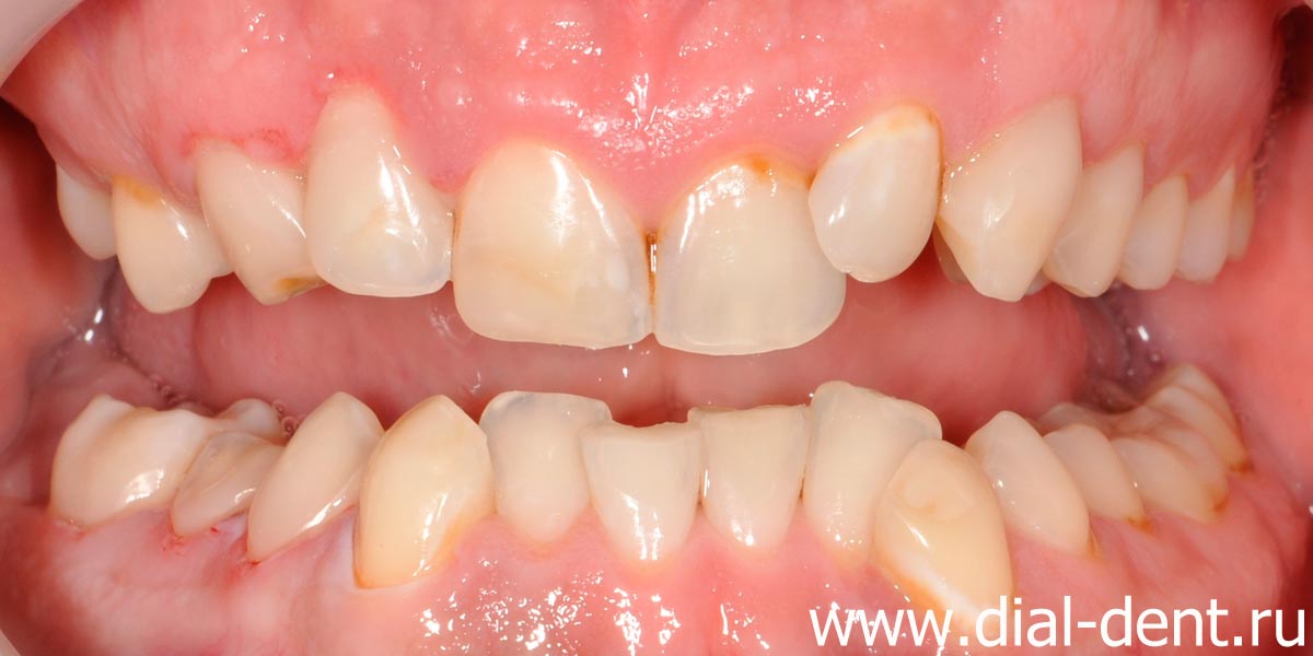 проведено лечение кариеса и восстановление разрушенного зуба