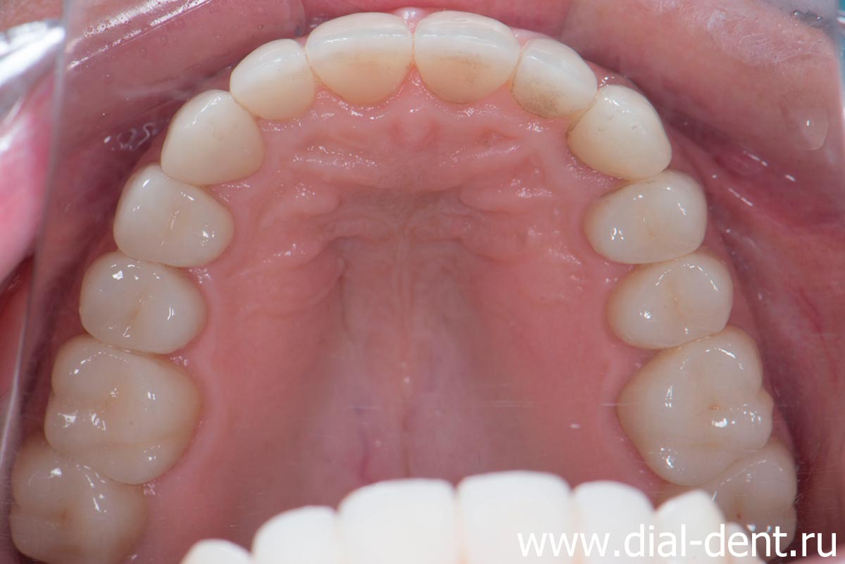 верхние зубы после протезирования