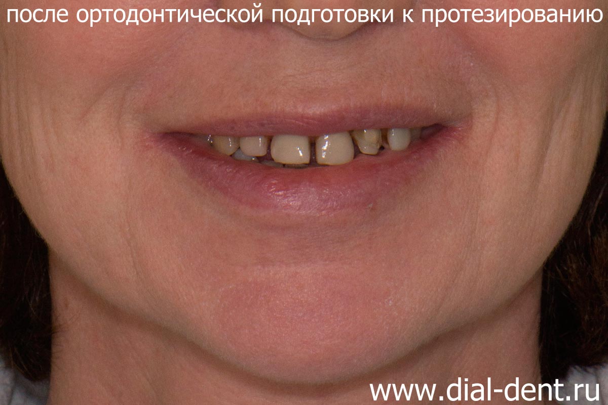после ортодонтической подготовки к протезированию зубов