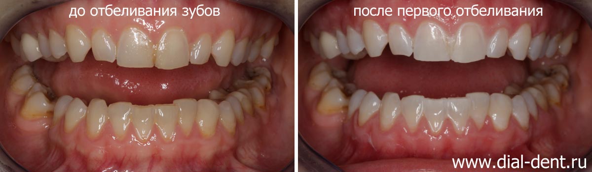 цвет зубов до отбеливания и после отбеливания ZOOM 4