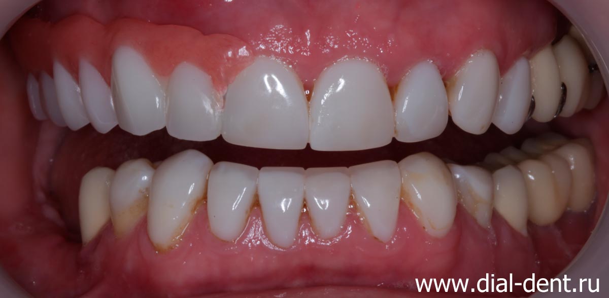 бюгельный зубной протез надежно держится во рту