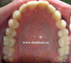 вид изнутри после проведенного лечения и реставрации зубов