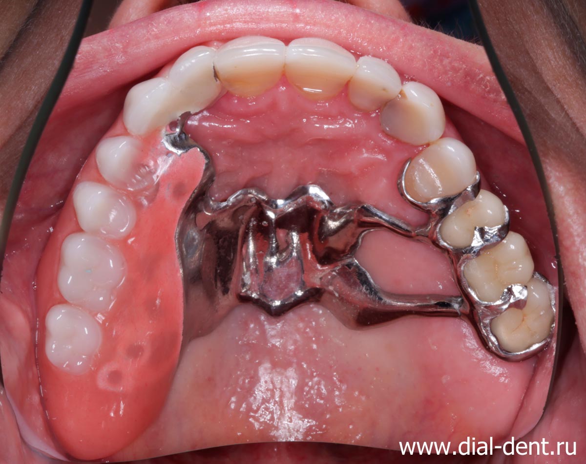 бюгельный протез для временной замены зубов